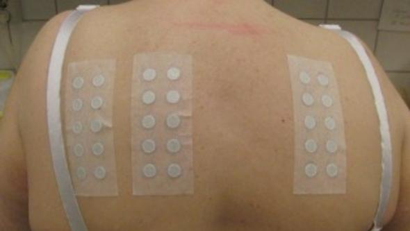Lapptest – eller så kallat epikutantest, applicerad på ryggen.